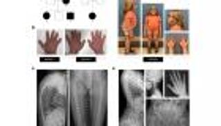 متلازمة كويتل.. اكتشاف سر مرض نادر في العظام