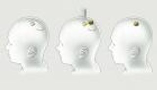 كيف تعمل شريحة إيلون ماسك الدماغية؟