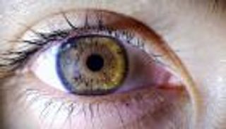 الأسبوع العالمي للجلوكوما 2024.. 5 خرافات شهيرة عن «سارق البصر»