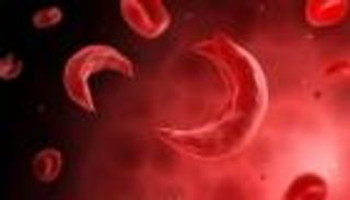 فقر الدم المنجلي.. ما هي الأعراض وأسباب الإصابة وطرق الوقاية والعلاج؟