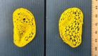 نسخة طبق الأصل.. إنتاج أذن بشرية باستخدام هندسة الأنسجة