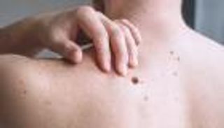 لقاح جديد لسرطان الجلد يفيد المرضى الرجال أكثر من النساء