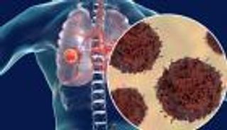 داوني بالتي كانت هي الداء.. علاج الأورام بخلايا سرطانية مبردة 