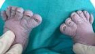 للمرة الثالثة.. سيدة تنجب طفلا بـ12 إصبعا في قدميه