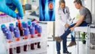 اختبار دم يكشف التهاب مفاصل الركبة قبل 8 سنوات من ظهوره