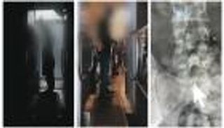 محاولة تهريب مخدرات داخل أحشاء مسافر في قطر.. شبو وهيروين