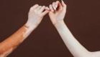 اليوم الدولي للتوعية بالمهق 2024.. 10 سنوات من مكافحة المرض والتمييز