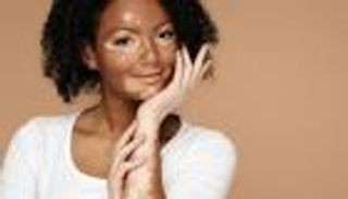 اليوم العالمي للبهاق 2024.. أساطير ومفاهيم خاطئة