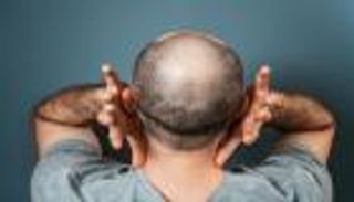 «ديوكسي ريبوز» طفرة في علاج الصلع.. سكر طبيعي آمن و«رخيص»