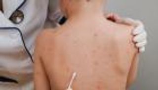 «جدري القرود» يستنفر العالم.. ترقب لإعلان «حالة طوارئ دولية»