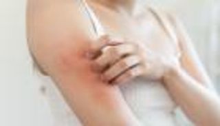 ما هي أسباب الحساسية الدوائية.. وأعراضها وطرق الوقاية منها؟