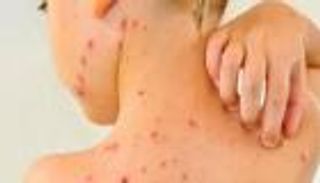 3 احتمالات رئيسية.. كيف يصاب الإنسان بـ جدري القرود؟