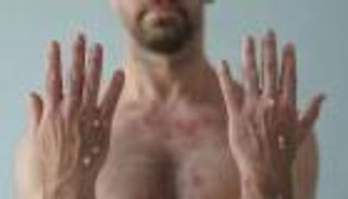 أوروبا تستعد لمزيد من حالات جدري القرود