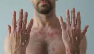 شخص مصاب بجدري القرود- أرشيفية