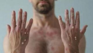 شخص مصاب بجدري القرود