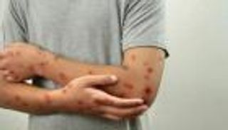 «المرض خطير».. مسؤول بارز يكشف حقيقة ظهور جدري القرود في مصر