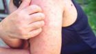 مرض كاواساكي (Kawasaki Disease).. ما هي أعراضه ومضاعفاته وكيفية علاجه؟