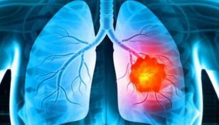 سرطان الرئة