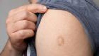 بشرى سعيدة.. تطعيم الطفولة يوفر «حماية مقبولة» ضد جدري القرود