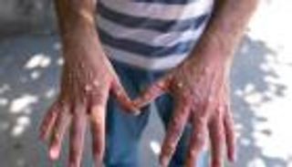 إصابة حالتين جديدتين بفيروس جدرى القرود في الفلبين