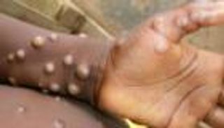 «الصحة العالمية» تعلن تحديث خطتها الاستراتيجية لمواجهة جدري القرود