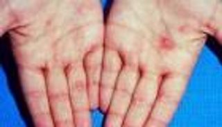 دراسة: بريطانيا تسجل أعلى حالات لـ«السيلان والزهري» في تاريخها