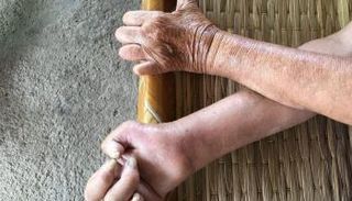 الجذام عدوى مزمنة