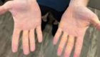 كوليسترول يخرج من الجلد.. كيف تسبب نظام اللحوم في حالة مرعبة؟