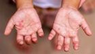 بيان رسمي يوضح حقيقة انتشار مرض «HFMD» في المدارس المصرية