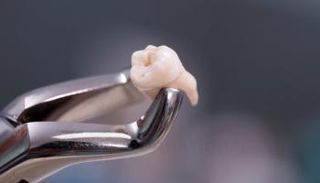 قلع أضراس العقل