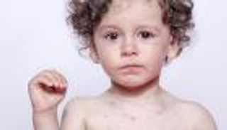 ارتفاع إصابات الحصبة في الولايات المتحدة بعد أكثر من 20 عاما