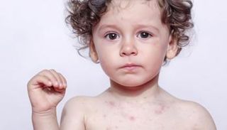 ارتفاع إصابات الحصبة في أمريكا