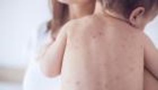 الولايات المتحدة تسجل أولى الإصابات المحلية بسلالة خطيرة من الجدري المائي