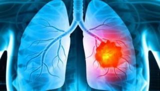 سرطان الرئة