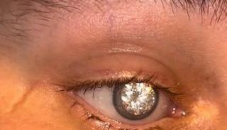 تاجر مجوهرات يزرع ماسة في عينه الصناعية