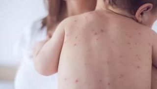 مرض الحصبة - تعبيرية