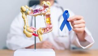 سرطان القولون