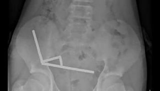 صبي يبتلع 100 مغناطيس