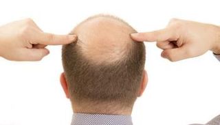 علماء يقتربون من حل جذري للصلع 