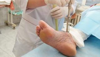 علاج تجريبي ينهي مشكلة جروح السكري المزمنة