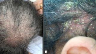 انتشار غير متوقع لعدوى فطرية تصيب فروة الرأس بين البالغين في تونس