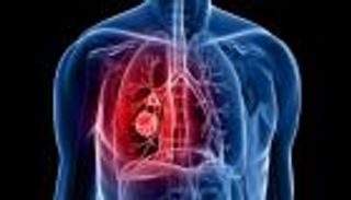 علماء يكتشفون المحرك الرئيسي لتطور سرطان الرئة في مراحله المبكرة
