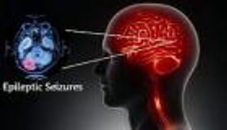 علاج غير جراحي يمنح الأمل في السيطرة الدقيقة على نوبات الصرع