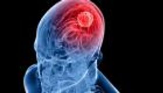 قطرات أنف تهزم أخطر أورام الدماغ.. تقنية جديدة تبشر بعلاج غير جراحي