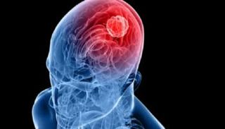 ابتكار علاج غير جراحي لأحد أخطر الأورام الدماغية 