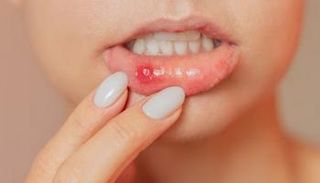 تقرحات الفم المتكررة قد تنذر بأمراض خطيرة
