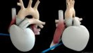 نهاية درامية لصراع طويل.. القلب الاصطناعي الفرنسي يعود للحياة