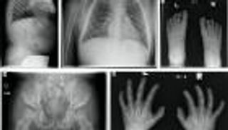 أول دراسة عراقية تكشف الخريطة الجينية لمرض موركيو (خاص)