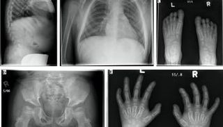 مرض موركيو يسبب مشكلات متعددة في القلب والعينين والمفاصل