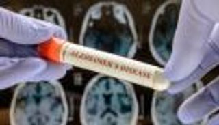 دواء لمرض ألزهايمر يحقق نتائج واعدة في تأخير الأعراض 8 سنوات